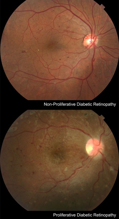 Diabetic RetinopathyPeople with diabetes are unfortunately at a higher