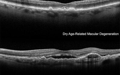 Macular HoleThe macula is the very small area in