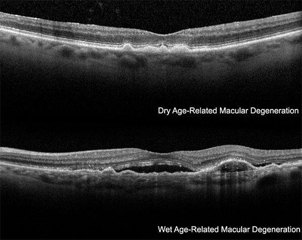 Macular HoleThe macula is the very small area in