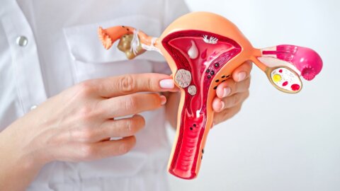 What You Should Know About Fibroids and Your Health