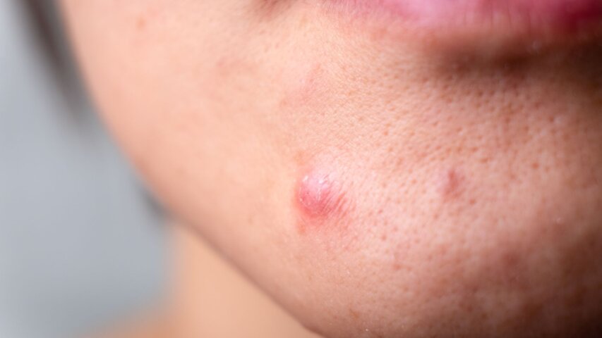 How Stress Can Affect Your Skin