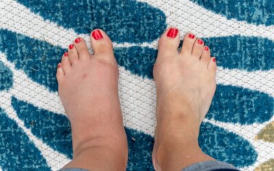 What Can Cause Swollen Feet and Ankles?