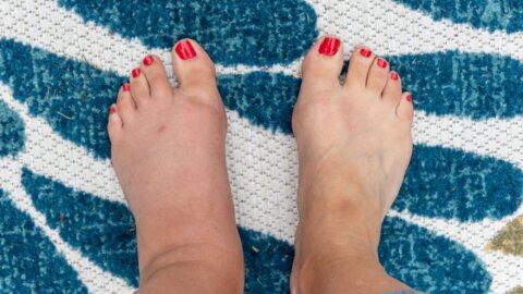 What Can Cause Swollen Feet and Ankles?