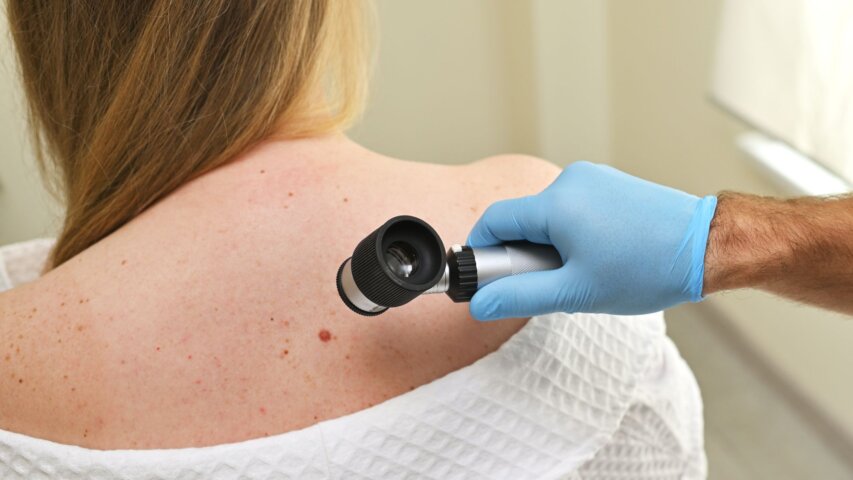 When Should a Mole Be Checked by a Dermatologist?